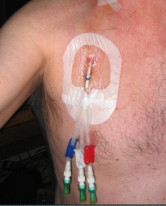 \"Elsie\" -- my port for stem cell harvesting, blood tests, and chemo infusions